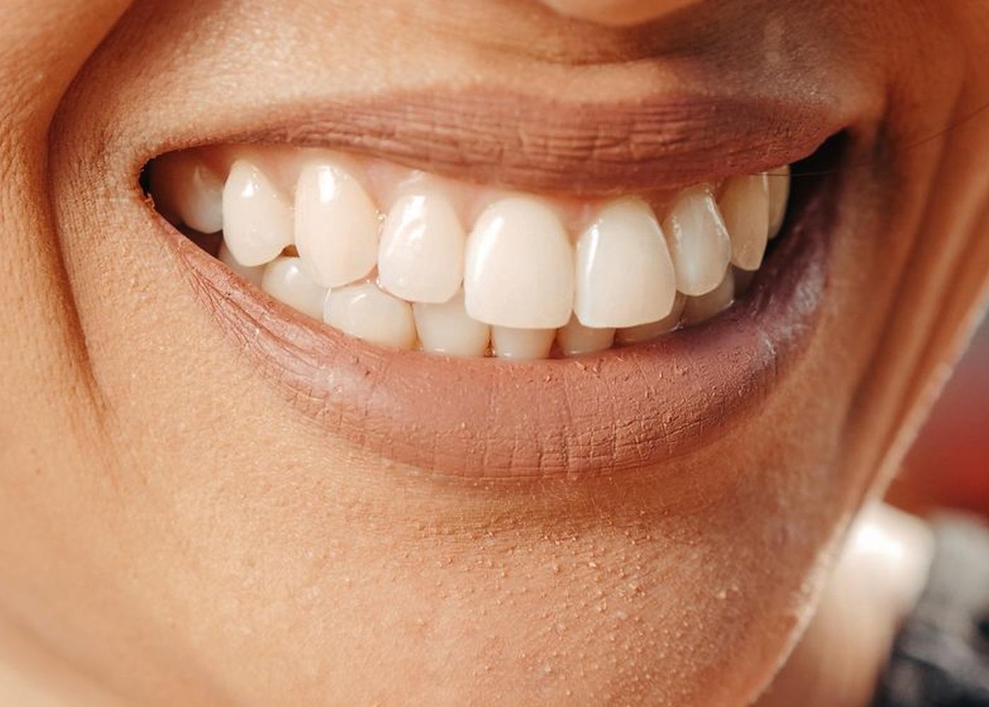 Smile after cosmetic dentistry