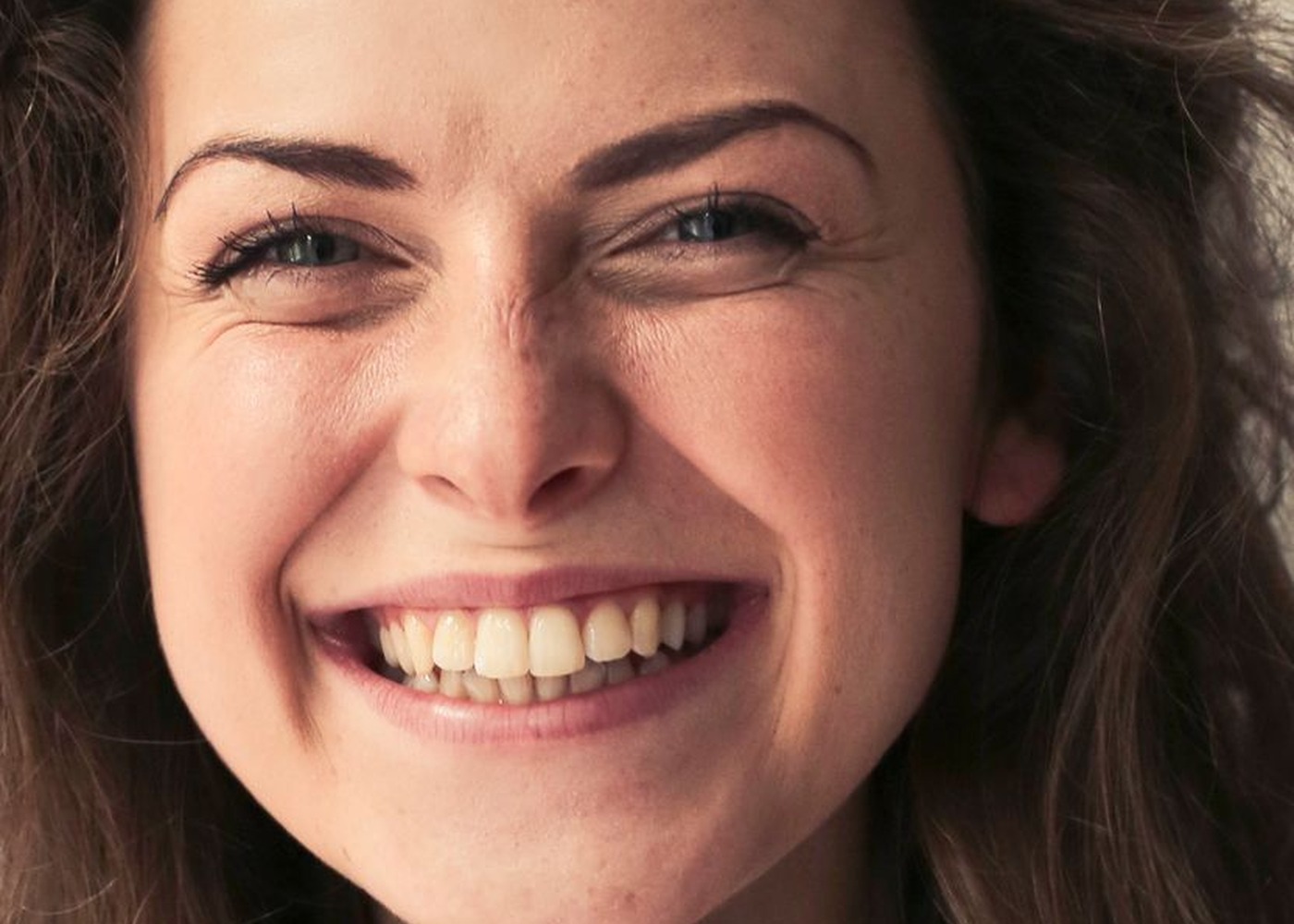Smile after implant restoration