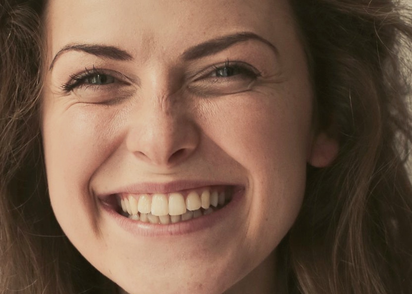 Smile before implant restoration