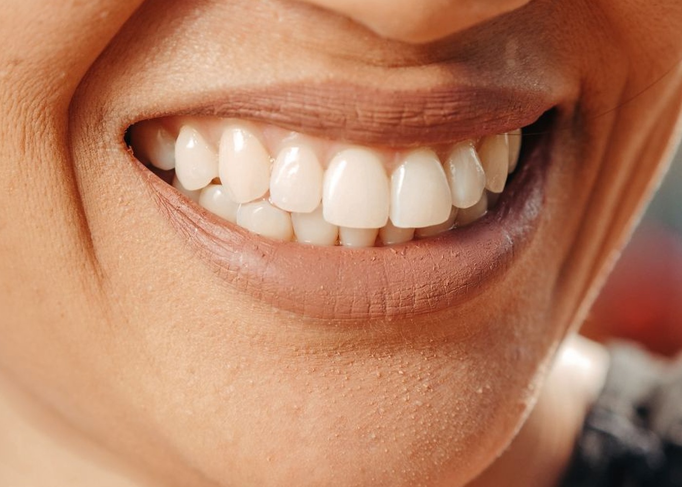 Teeth after whitening