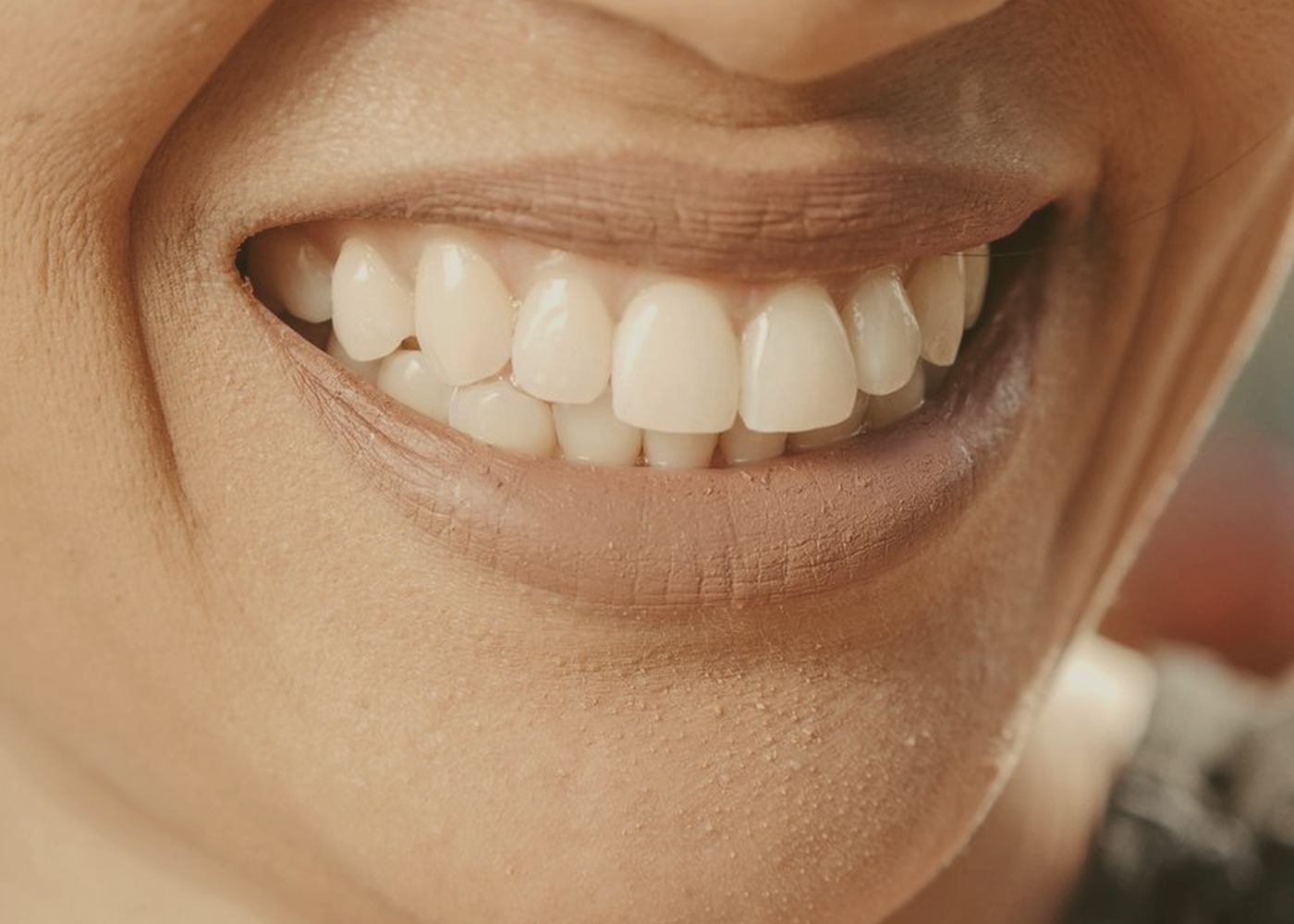 Teeth before whitening